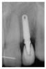 Figure 17  Immediate postoperative digital periapical; left lateral incisor.