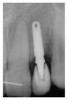 Figure 17  Immediate postoperative digital periapical; left lateral incisor.