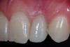 Figure 20  3-month postoperative clinical view, left lateral incisor.