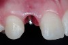 Figure 21  Tissue emergence profiles, right lateral incisor.