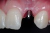 Figure 22  Tissue emergence profiles, left lateral incisor.