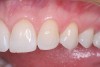 Figure 7  The canine teeth were moved mesially into the space left by the congenitally missing lateral incisors.
