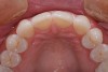 Figure 8  Having the premolars in the position of the canine leaves inadequate contour to provide disclusion of the posterior teeth. Note how the incisal plane moves apically after passing the lateral position.