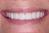 Figure 10  The final full smile of case two. Veneers cemented with NX3, Kerr.