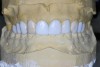 Figure 13  Diagnostic wax-up for case three. Due to existing restorations and decay, full-coverage restorations were indicated. The new restorations would be fabricated with idealize contour to allow proper anterior guidance.