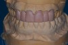 Figure 2  The proposed gingival alteration marked on the cast.