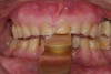 Figure 4  Inter-occlusal registration made at the approximate OVD for rehabilitation.