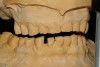 Figure 5  Laboratory alteration of the gingival contours in diagnostic wax-up.