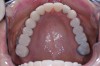 Figure 21  Occlusal view of the reduction matrix.