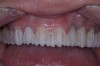 Figure 22  Facial and incisal reduction on the matrix.