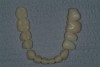 Figure 25  The provisional is segmented based on how the case is to be impressed and how the inter-occlusal record is to be fabricated.