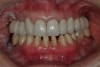 Figure 26  Anterior provisionals are removed and the patient closes into bite registration. The posterior teeth are adjusted to centric relation.