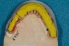 Figure 29  Accurate interocclusal registration demonstrating no overlap of material between the three segments.