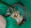 Figure 4   Adhesive is applied and gently air-dried and light-cured per the manufacturer’s suggestion. The cavity is then filled with the dentin replacement composite, shade A-3, and shaped like the dentin underlying the cusps of the tooth. This composite is then light-cured.