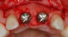 Figure 3  Periapical radiograph of implants in the Nos. 8 and 9 sites 3 years after placement. A bony peak was still present between the implants due to successful guided bone regeneration and favorable fixture spacing.