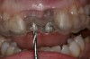 Figure 9   Periapical radiographs of the final implants show good bone levels and interproximal spacing between the implants and adjacent teeth.