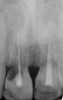 Figure 14  Buccal view of the implants immediately after provisionalization. Even at the temporary stage, the soft tissue closely mimicked the original periodontal drape.