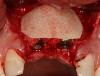 Figure 17   Freeze-dried bone allograft over a layer of autogenous bone was used to cover the dehiscences.
