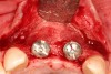 Figure 20   The periapical radiograph at 6 months shows sufficient peri-implant bone.