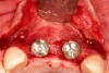 Figure 20   The periapical radiograph at 6 months shows sufficient peri-implant bone.